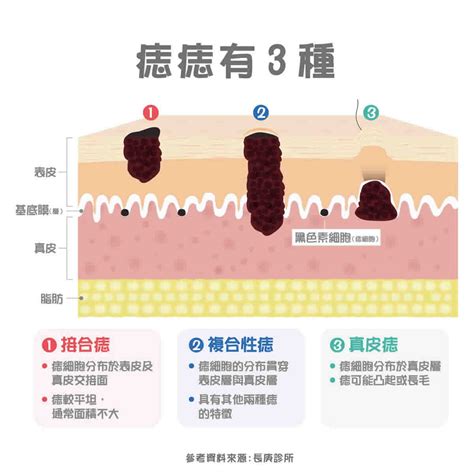 長痣原因|痣形成的原因？痣長毛、痣變多變大是痣病變？5招判。